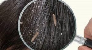 Dandruff Causes, Symptoms, and Effective Treatments